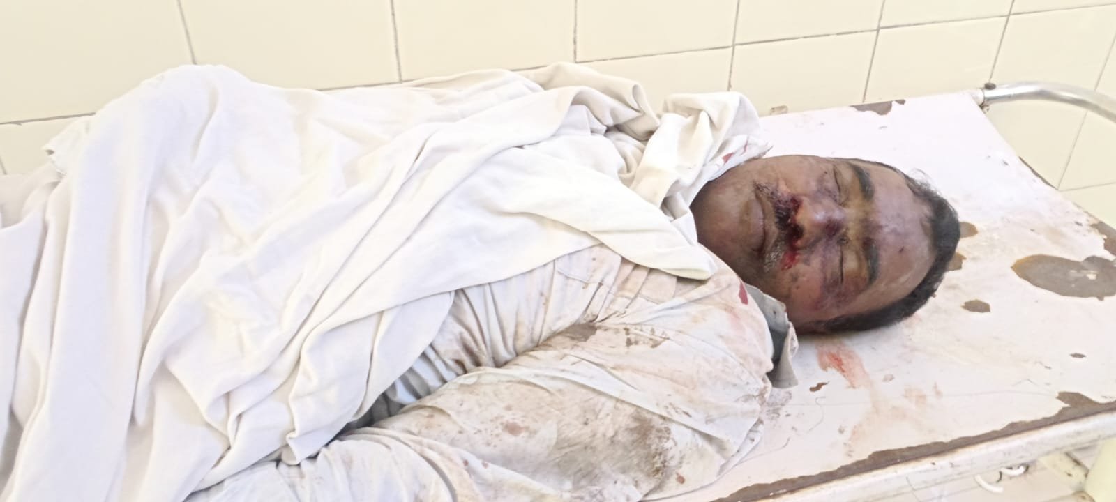 उरीमारी ओपेन कास्ट में ब्लास्टिंग के लिए बने होल में चार्जिंग के दौरान विस्फोट